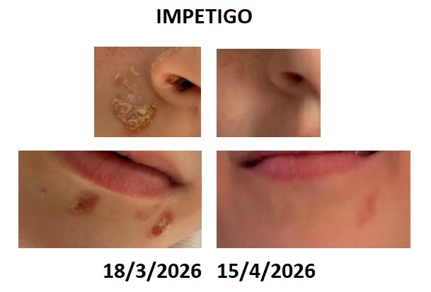 Impetigo treated with homeopathy